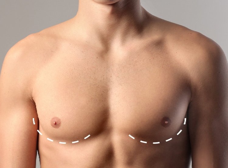 Gynecomastia in Dubai: Enhancing Confidence Through Expert Care